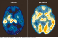 PET scan comparing brain activity during periods of depression (left) with normal brain activity (right).